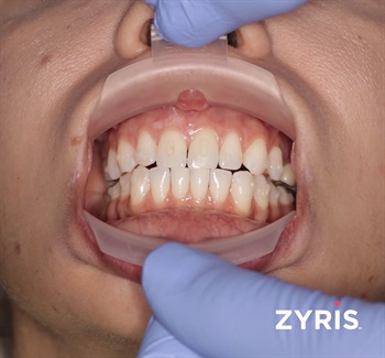 Zyris Launching New Dental Retractor at Chicago Midwinter