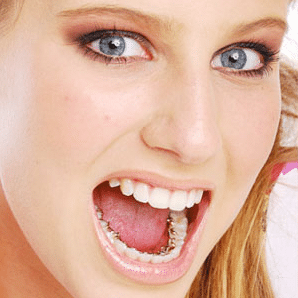 Hidden Braces, Visible Results: Is the Behind-the-Teeth Option Right for You?
